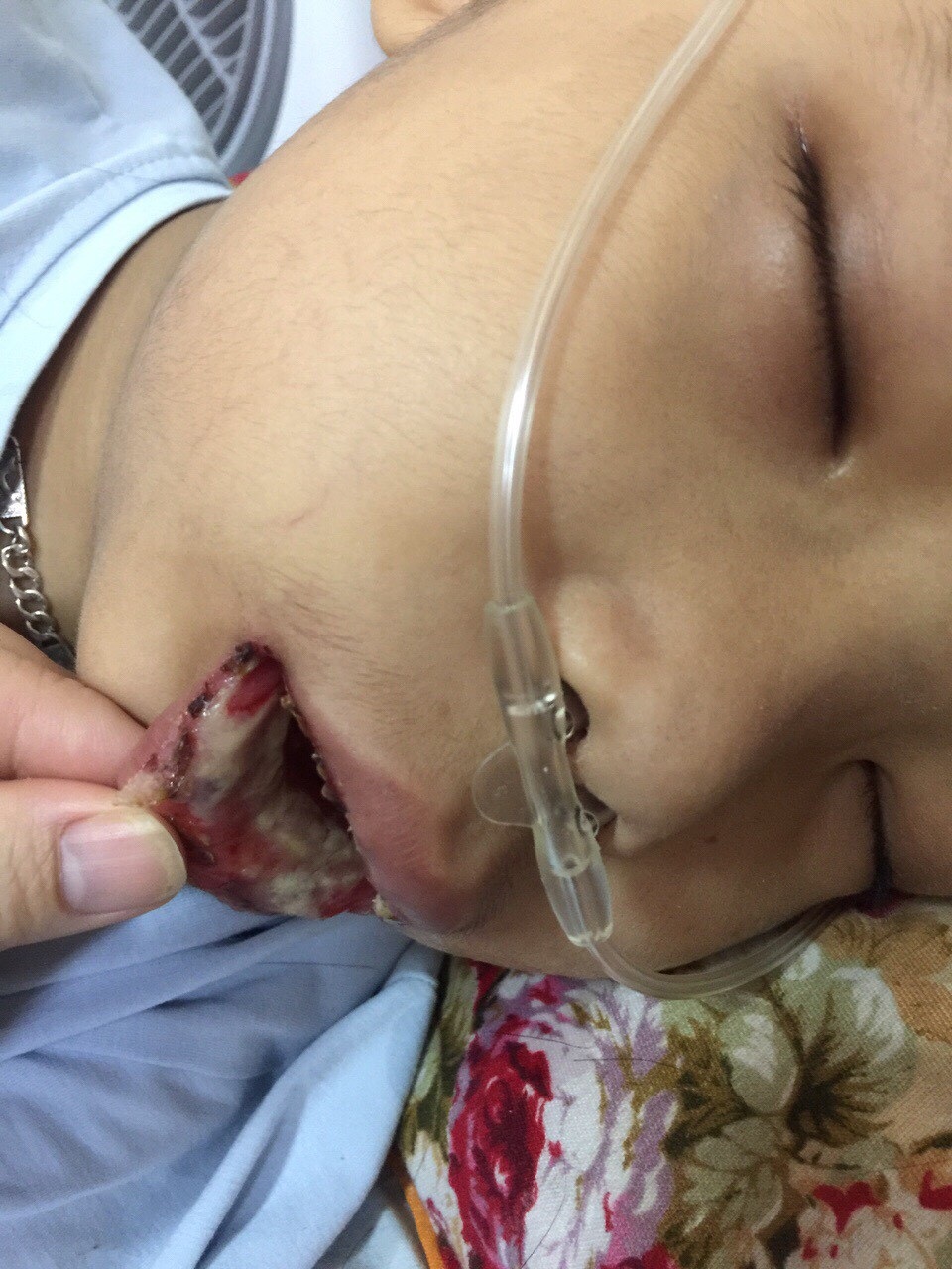 Hơn 245 triệu đồng đến với cậu bé Dương bị ung thư máu - 2 Phần môi của con bị loét hết cả ra nên cậu bé rất đau đớn.