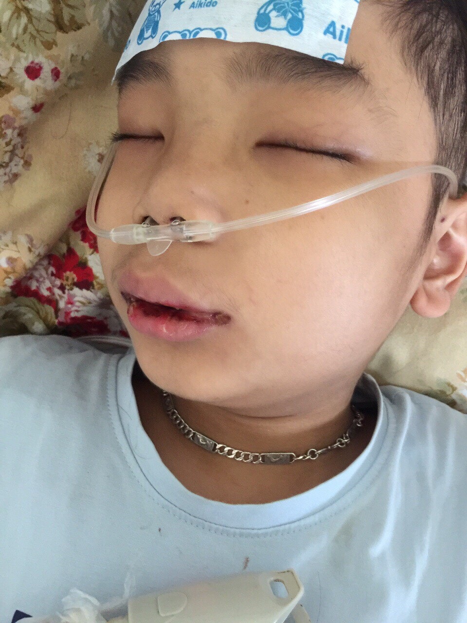 Hơn 245 triệu đồng đến với cậu bé Dương bị ung thư máu - 1 Cậu bé được chẩn đoán bị là u lympho ác tính lan tỏa tế bào T ở giai đoạn 2b với thể bệnh không thuận lợi.