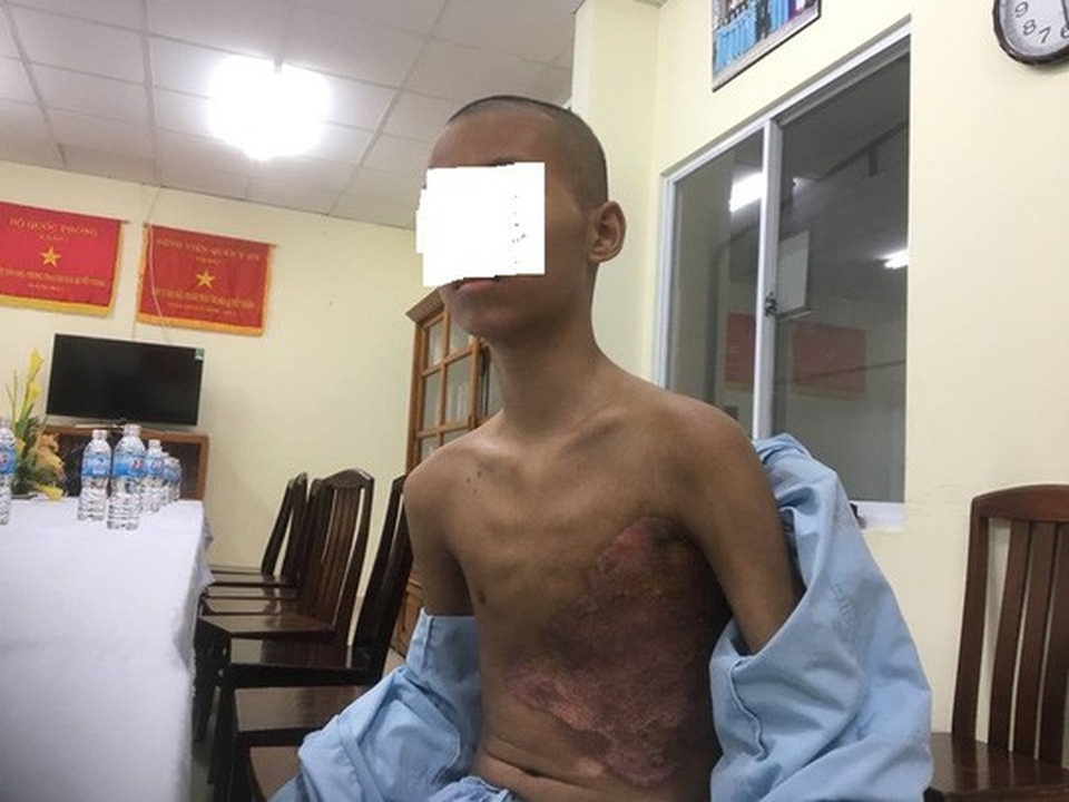 Bị xe buýt tông, 1 bé trai dập phổi và gãy 5 xương sườn - 1 Bệnh nhi M. đã bình phục khi được các BS BV 175 mổ cấp cứu thành công. Ảnh. M.Thương