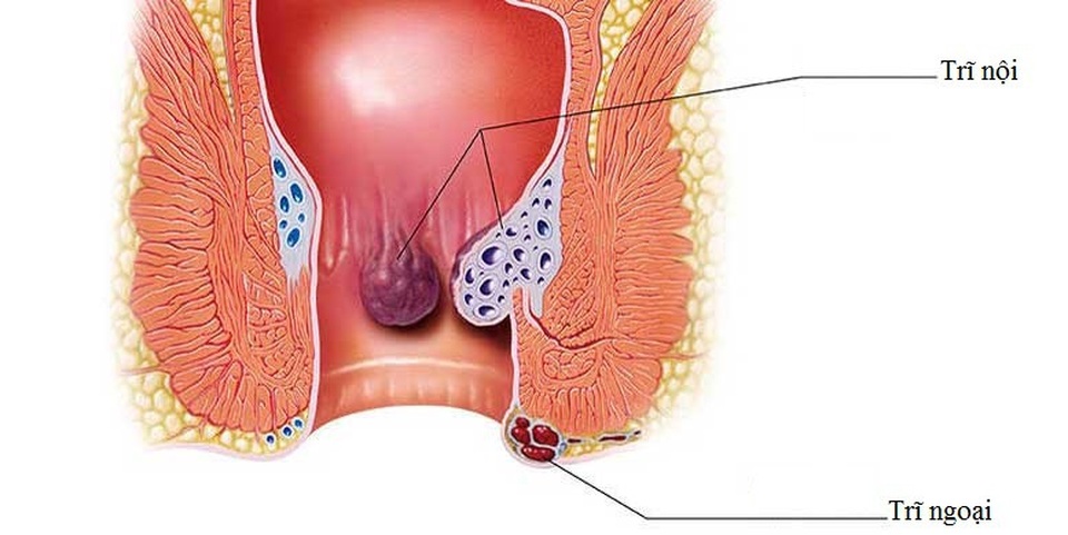 Bạn sẽ “khổ cả đời” vì trĩ nếu không bỏ những thói quen này - 1 Bệnh trĩ rất dễ mắc nhưng lại khó điều trị dứt điểm, gây ảnh hưởng xấu tới sức khỏe và chất lượng cuộc sống của người bệnh.
