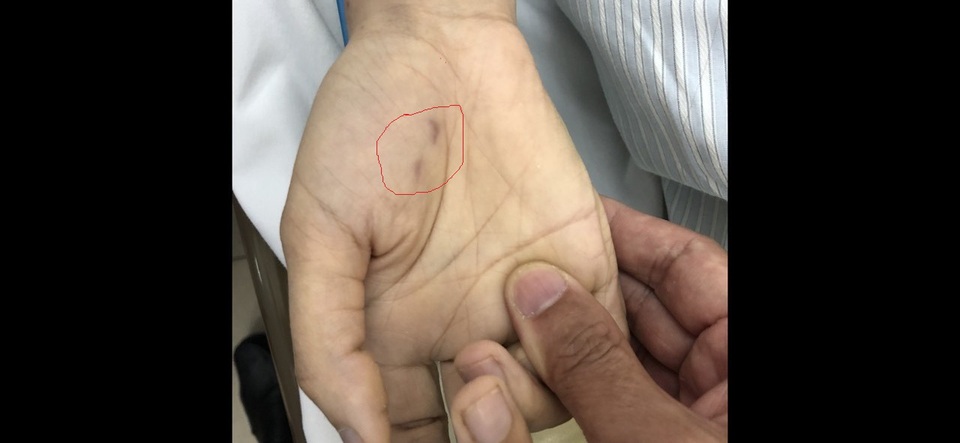 Bị chó cắn, nữ bác sĩ thú y tử vong vì chủ quan không tiêm phòng - 1 Vết cắn rất nhỏ, đã liền trên tay bệnh nhân.
