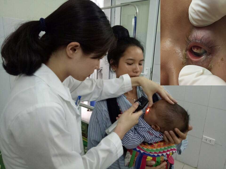 Thêm bệnh nhi hỏng mắt vì nhỏ sữa mẹ chữa đỏ mắt - 1
Bé K. đang được kiểm tra mắt trước khi phẫu thuật