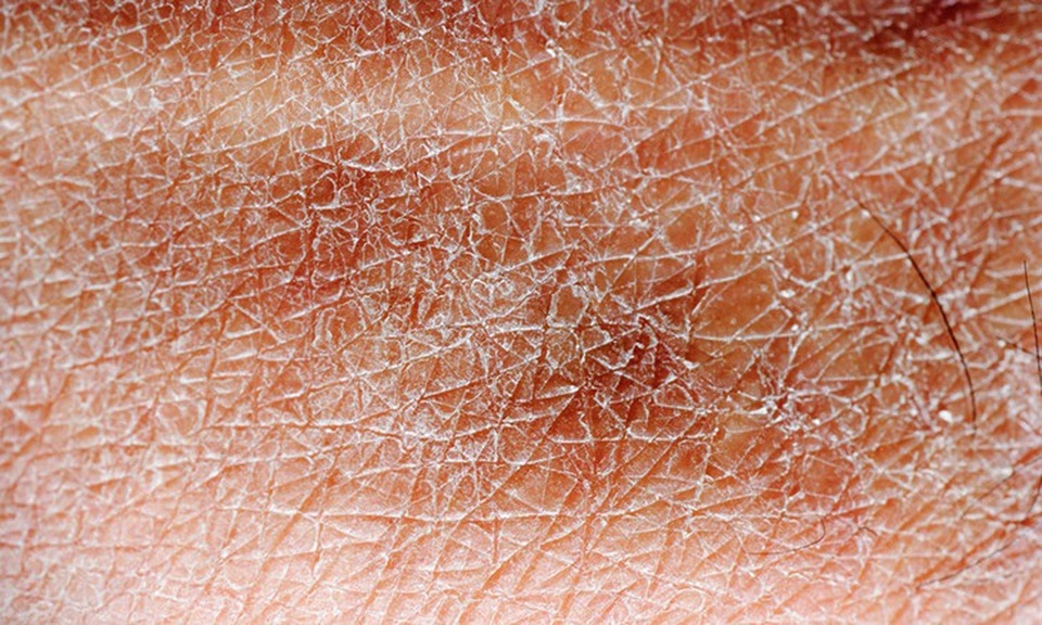 10 kiểu ngứa da càng gãi càng nguy hiểm - 1 10 kiểu ngứa da càng gãi càng nguy hiểm - 1