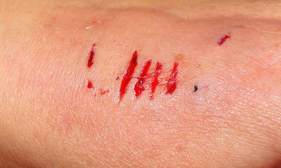 10 kiểu ngứa da càng gãi càng nguy hiểm - 3 10 kiểu ngứa da càng gãi càng nguy hiểm - 3