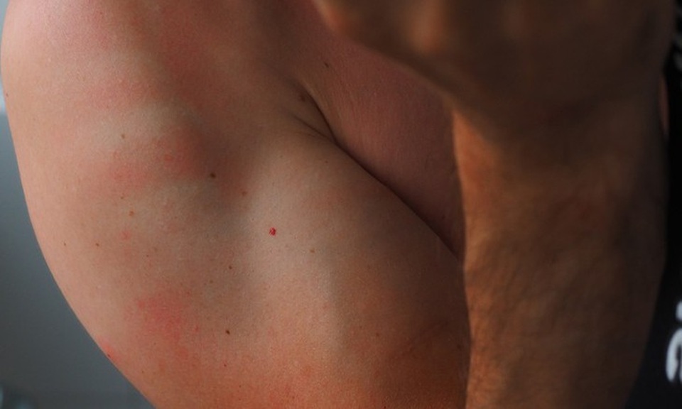 10 kiểu ngứa da càng gãi càng nguy hiểm - 4 10 kiểu ngứa da càng gãi càng nguy hiểm - 4