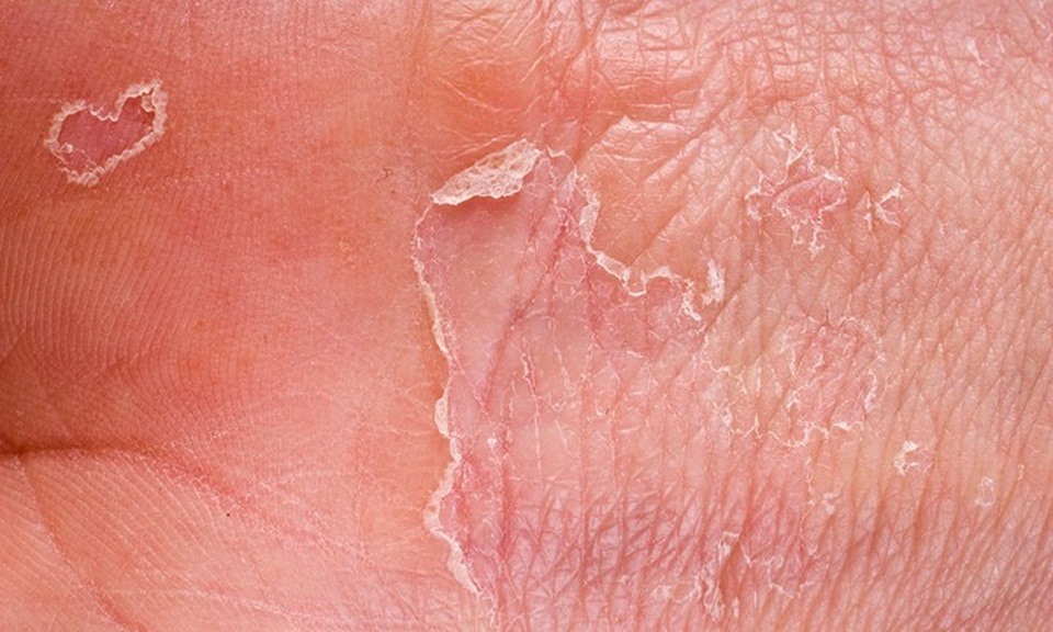 10 kiểu ngứa da càng gãi càng nguy hiểm - 5 10 kiểu ngứa da càng gãi càng nguy hiểm - 5