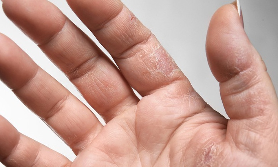 10 kiểu ngứa da càng gãi càng nguy hiểm - 7 10 kiểu ngứa da càng gãi càng nguy hiểm - 7