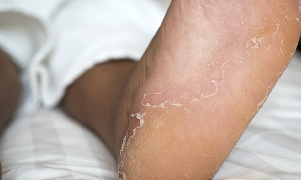 10 kiểu ngứa da càng gãi càng nguy hiểm - 9 10 kiểu ngứa da càng gãi càng nguy hiểm - 9