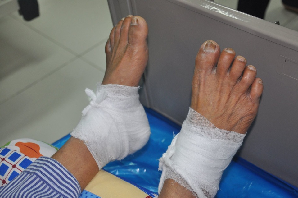 Chườm lá ngải cứu rang nóng, bệnh nhân bị bỏng nặng - 1 Ông T. vẫn đang bị bỏng nặng, phải nhập viện điều trị vì đắp lá ngải cứu rang.