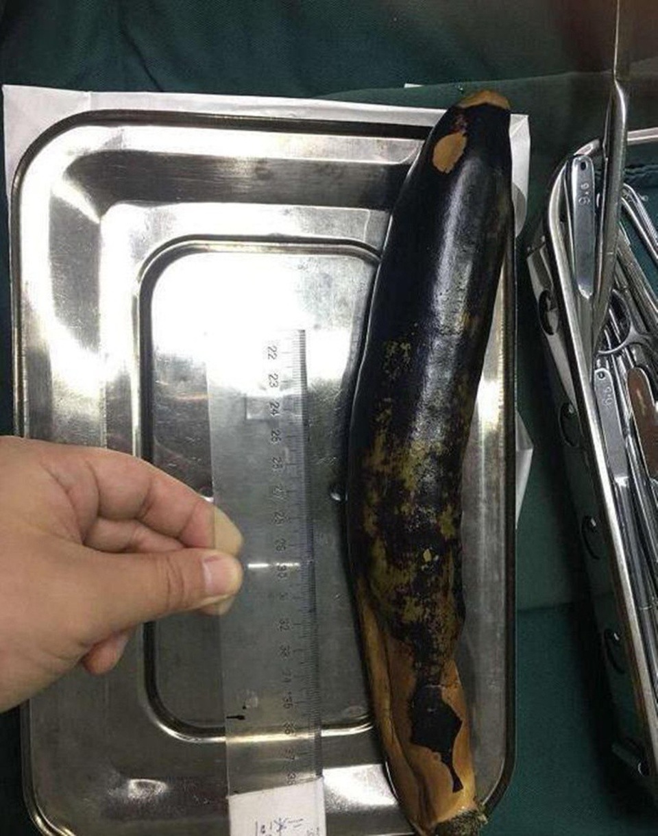 Quả cà hầu như vẫn còn nguyên vẹn sau khi lấy ra khỏi cơ thể bệnh nhân