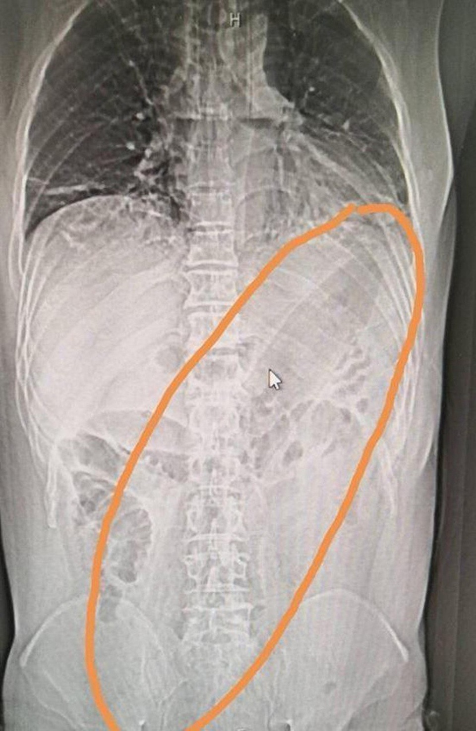 Thứ quả bình thường suýt chạm vào cuống tim và trở thành thủ phạm giết người