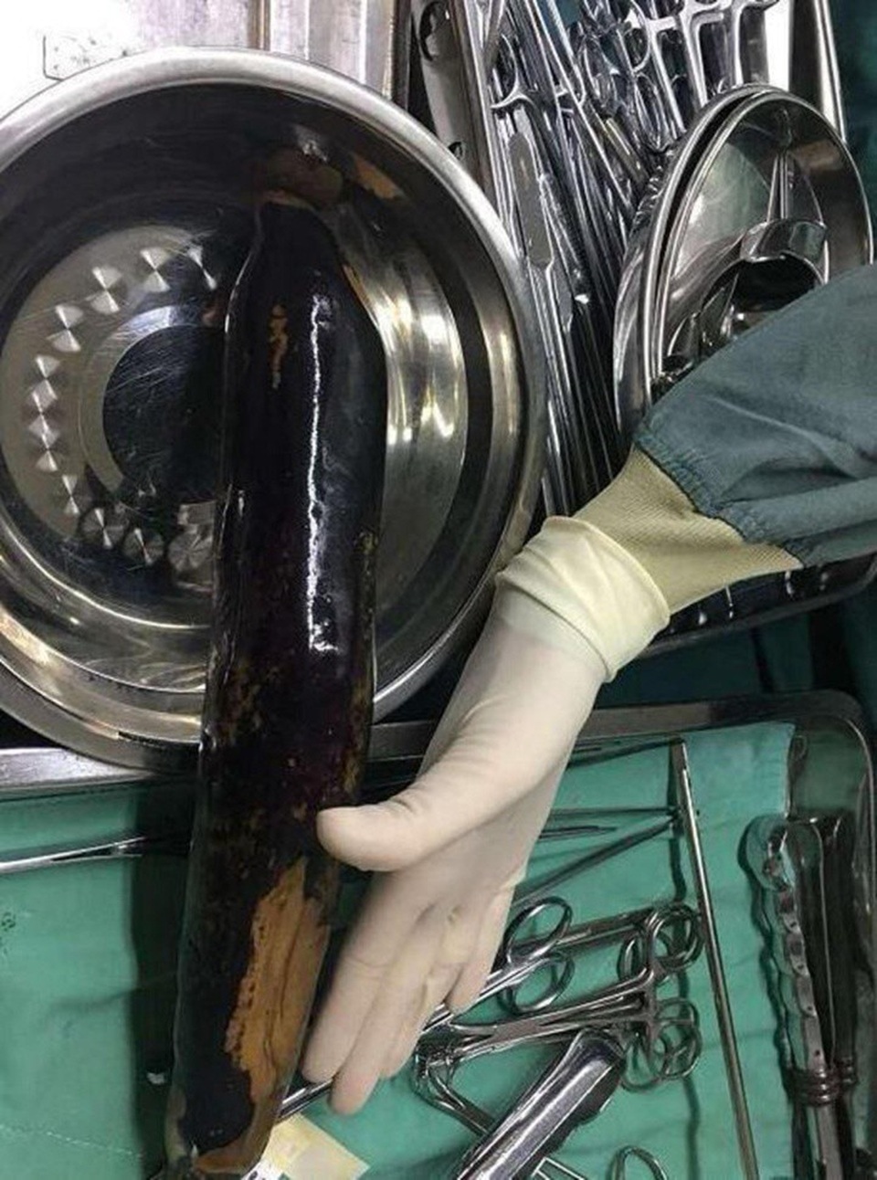 Bác sĩ cũng choáng váng khi lấy được quả cà ra khỏi cơ thể bệnh nhân