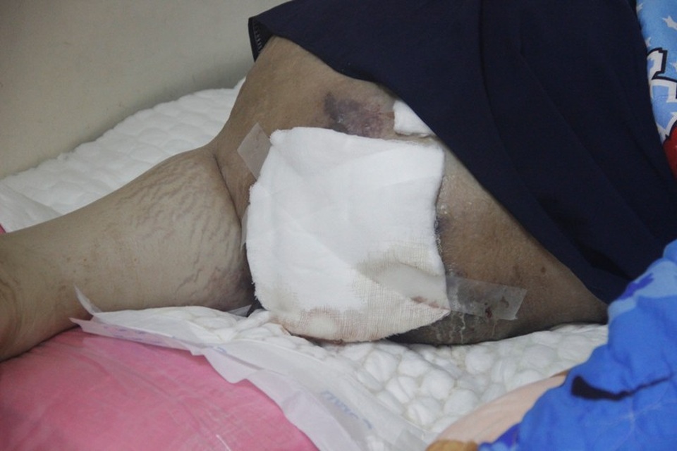 Sự sống mong manh của cậu bé mang chân phình to như… cột nhà - 7 Cháu An bị liệt nằm một chỗ hơn 10 tháng nay