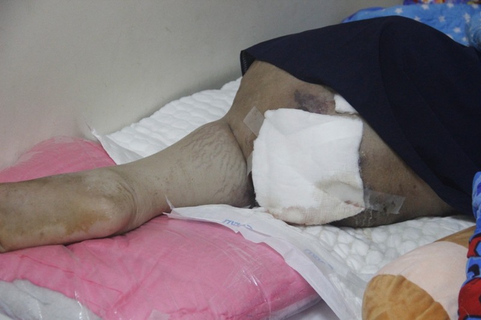 Sự sống mong manh của cậu bé mang chân phình to như… cột nhà - 4 Đôi chân của cháu phình to, bưng mủ