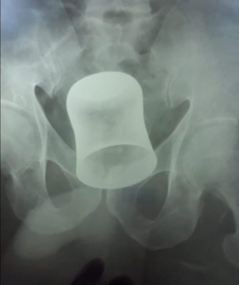 Giải cứu người đàn ông khốn khổ sau 10 ngày bị nhét cốc vào hậu môn - 2 Ông bị tấn công vào tháng 6 vừa rồi