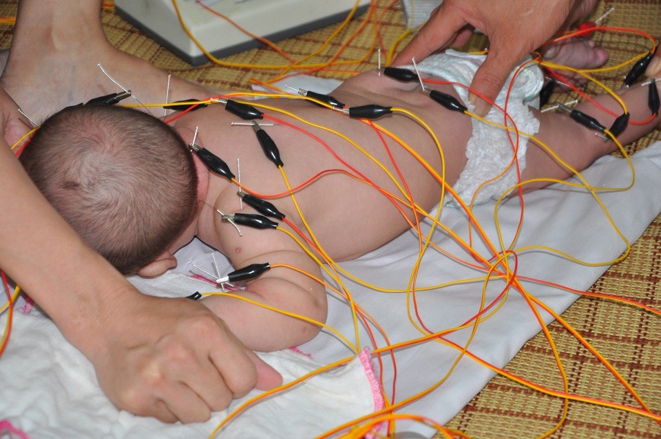 Nỗi đau đớn tột cùng của gia đình nghèo có con lớn chết đuối, hai con nhỏ bại não - 9 Cả cơ thể non nớt của Cẩm Tú dưới những mũi kim.
