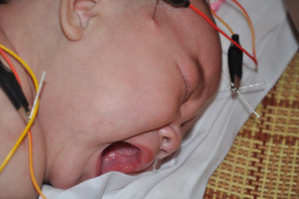 Nỗi đau đớn tột cùng của gia đình nghèo có con lớn chết đuối, hai con nhỏ bại não - 7 Cô bé 4 tháng sớm chịu nhiều đau đớn.