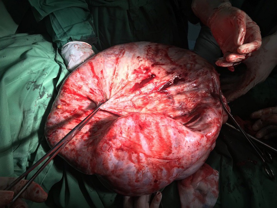 Cô gái trẻ chưa chồng mang khối “thai giả” nặng 17kg - 2 Khối u khổng lồ nặng tới 17kg được bác sĩ bóc tách lấy ra ngoài thành công