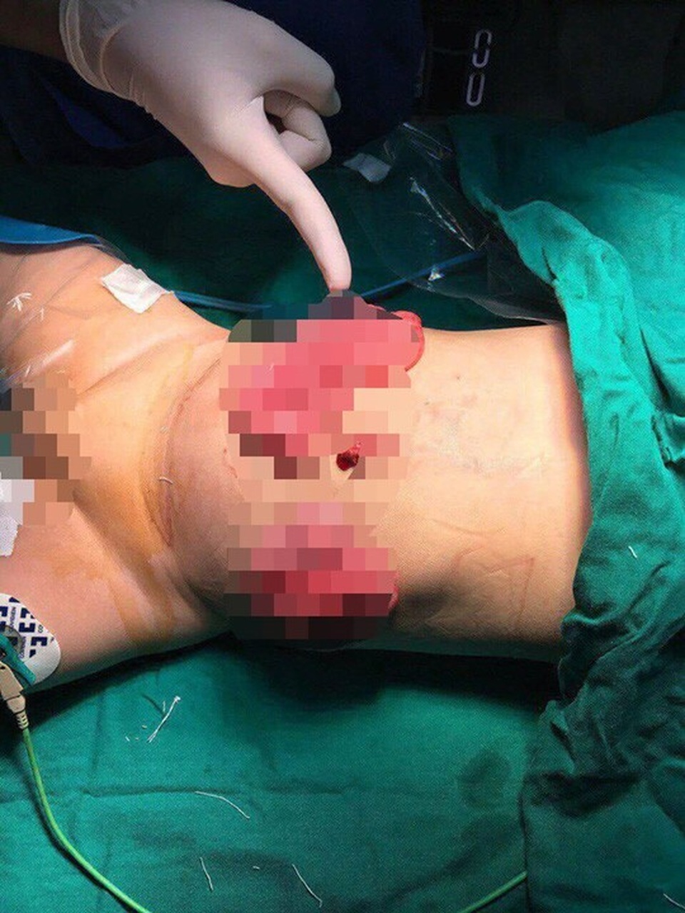 Cứu bé 11 tháng tuổi bị mẹ tâm thần đâm thủng ruột - 1
Bé trai 11 tháng tuổi bị mẹ đâm nhiều nhát