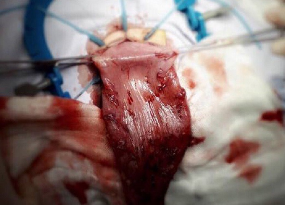 Ruột bệnh nhi bị giãn lớn đã được bác sĩ cắt bỏ