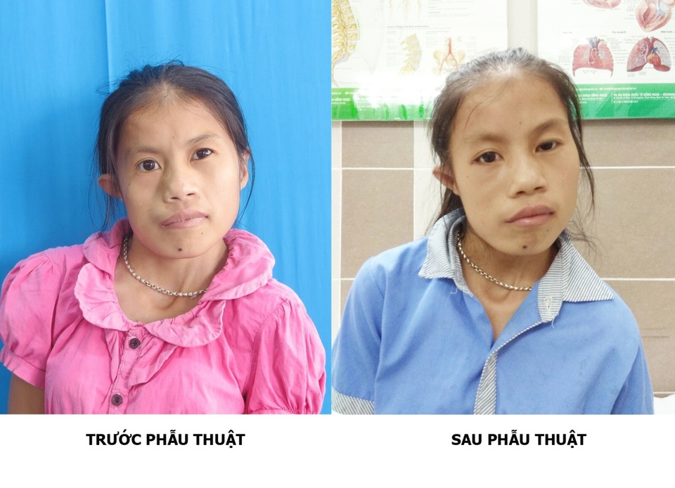 Phép màu xuất hiện sau 20 năm cuộc đời của cô gái trẻ Thái Nguyên - 4 Phú sẽ còn phải trải qua nhiều lần phẫu thuật nữa để hoàn thiện khiếm khuyết của tạo hóa nhưng dị tật của em đã được cải thiện phần nào sau lần phẫu thuật đầu tiên