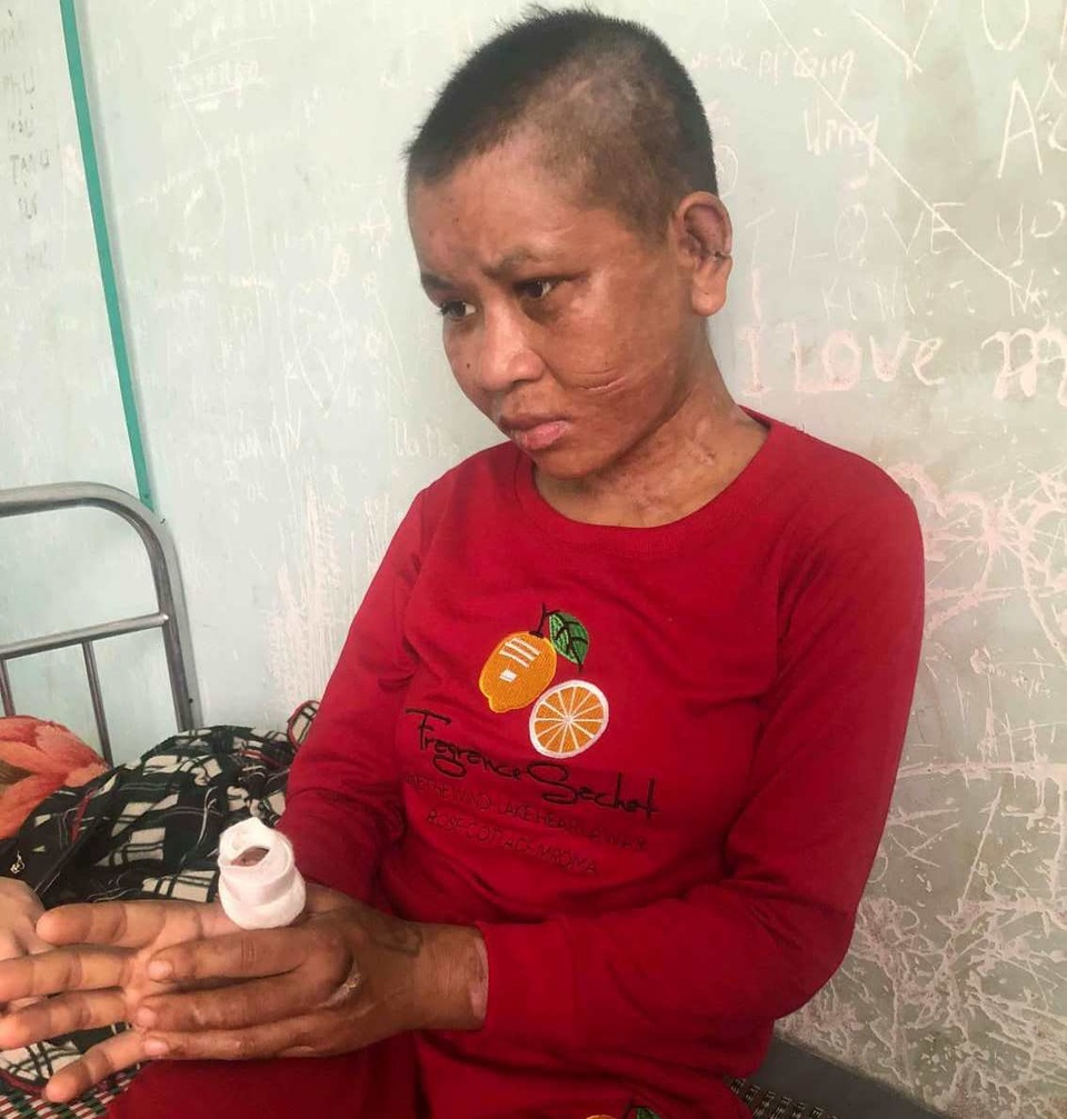 Vụ chủ nhà tra tấn dã man người làm thuê: Bệnh viện phẫu thuật thẩm mỹ miễn phí cho nạn nhân - 1 Thân hình chị Y Nhiêu bị biến dạng sau những trận đòn roi của chủ nhà