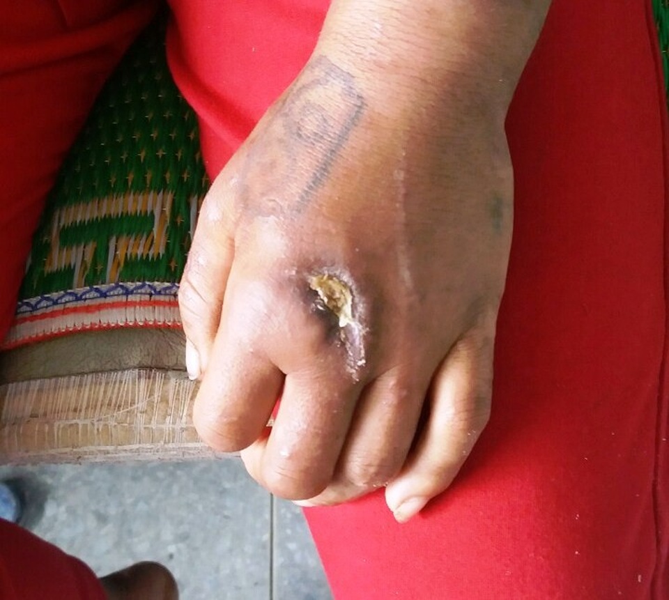 
Tay bị bàn là và thanh sắt nung nóng áp mạnh vào gây tổn thương.
