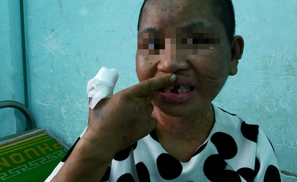 Hành trình chạy trốn khỏi "địa ngục trần gian" của cô gái bị tra tấn dã man - 1 Sau khi bị dùng búa đánh nhưng không gãy răng, kẻ thủ ác dùng kìm bẻ gãy 3 chiếc răng Y Nhiêu