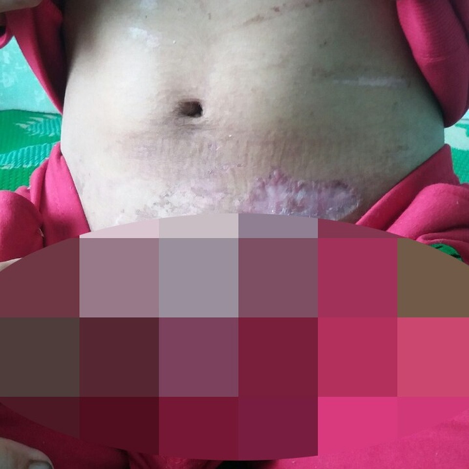 Vụ bạo hành người giúp việc: Người chủ nói gì? - 3 Vùng kín của chị Y Nh cũng bị người chủ đánh, xuất hiện nhiều mảnh sẹo lớn