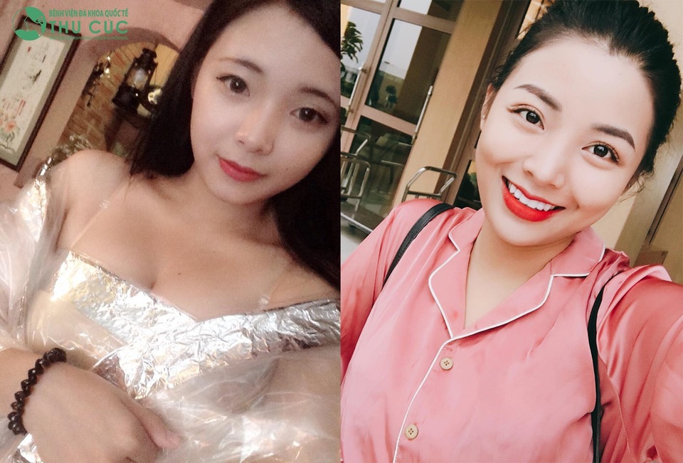 Giải mã xu hướng mắt to “bồ câu” của giới trẻ - 4 Thần thái khác biệt của đôi mắt trước và sau khi thực hiện dịch phẫu thuật mắt của khách hàng tại Bệnh viện ĐKQT Thu Cúc