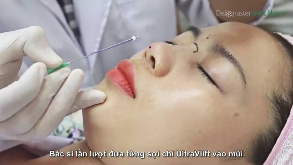 Chọn chỉ sinh học nâng mũi an toàn, không biến chứng theo tư vấn của bác sĩ - 1 Nâng mũi bằng chỉ là phương pháp xâm lấn nội khoa cần được thực hiện bởi bác sĩ chuyên môn.