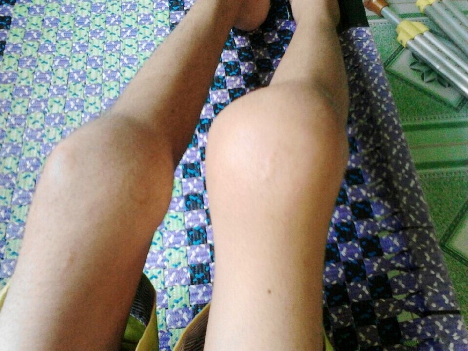 "Mỗi lần chân đau nhức, cháu chỉ biết thức trắng đêm nằm khóc !" - 3 Căn bệnh rối loạn đông máu khiến hai đầu gối sưng to, đau nhức, không đi lại được