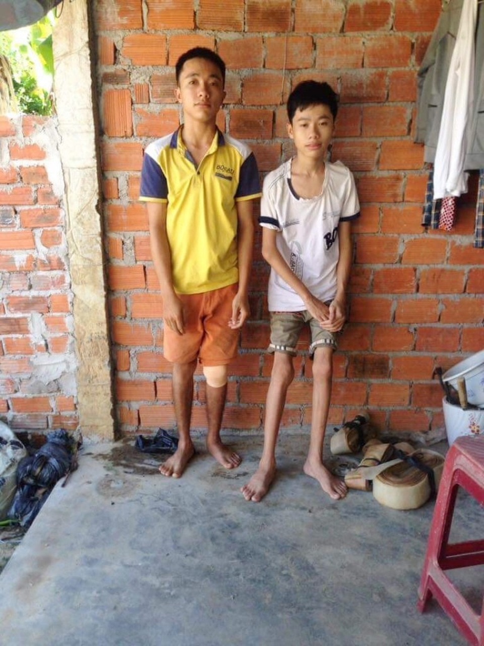 "Mỗi lần chân đau nhức, cháu chỉ biết thức trắng đêm nằm khóc !" - 4 Hai anh em Sĩ và Linh mắc bệnh rối loạn đông máu bẩm sinh, thân hình gầy gò ốm yếu, hai đầu gối sưng vù vì bệnh trong căn nhà tồi tàn của dì Thi ở quê Quảng Ngãi