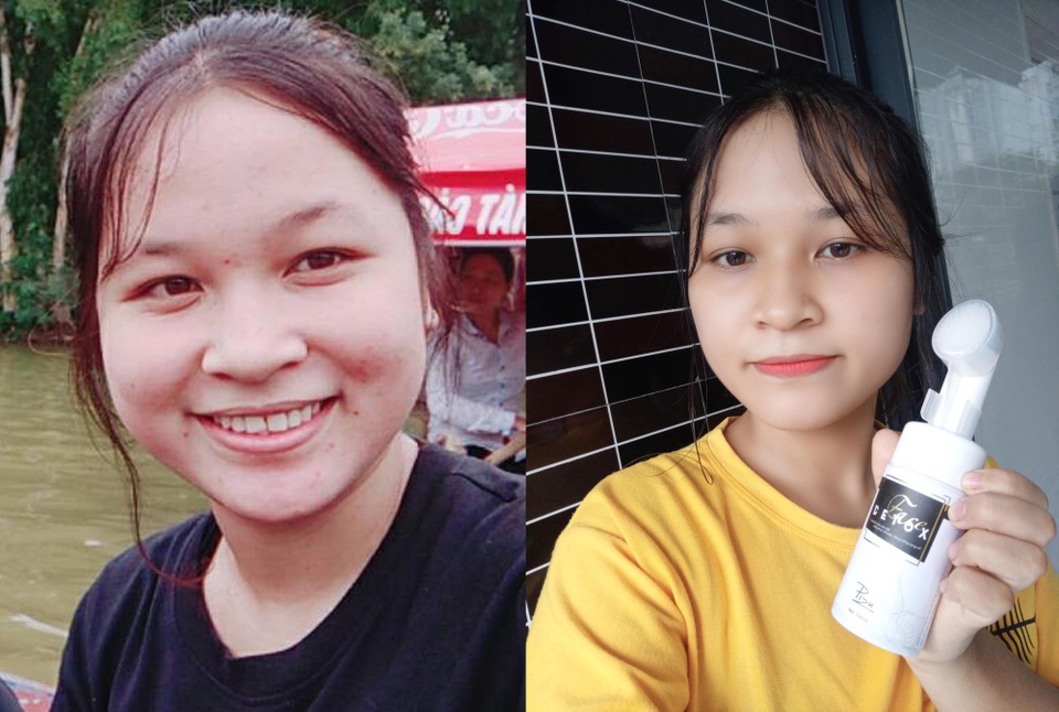 Giải mã cơn sốt mang tên Face Detox - tắm truyền trắng cho da mặt - 4 Giải mã cơn sốt mang tên Face Detox - tắm truyền trắng cho da mặt - 4