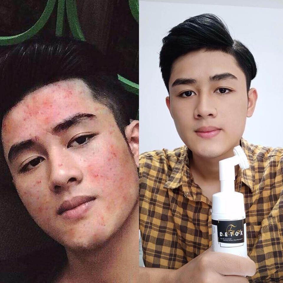 Giải mã cơn sốt mang tên Face Detox - tắm truyền trắng cho da mặt - 7 Giải mã cơn sốt mang tên Face Detox - tắm truyền trắng cho da mặt - 7