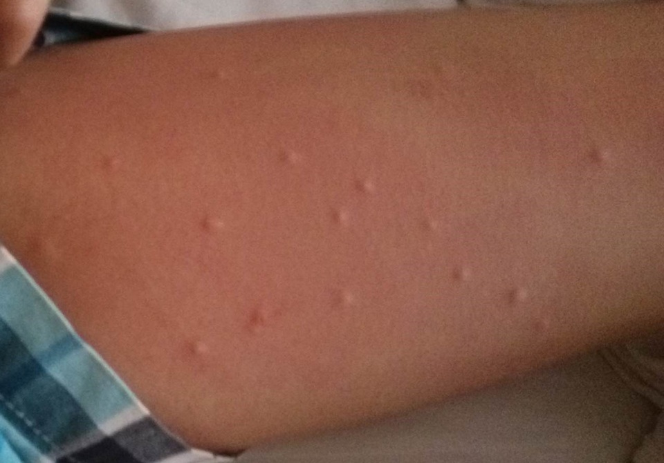 
Chị Thái cho biết, các thành viên trong gia đình chị đều có hiện tượng nổi mẩn đỏ khi tắm biển Đà Nẵng. Ảnh: Thanh Thái
