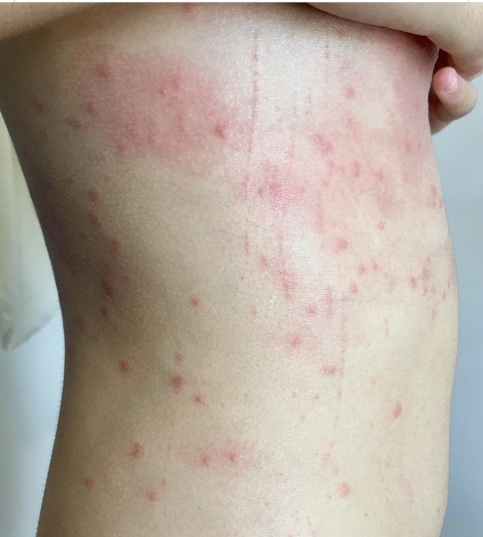 Dân tắm biển bị nổi mẩn đỏ, đại biểu “truy” Giám đốc Sở Tài nguyên - Môi trường - 1 Nhiều người dân và du khách phản ánh tình trạng bị ngứa và nổi mẩn đỏ sau khi tắm biển ở Đà Nẵng trong thời gian gần đây. Giám đốc Sở TN-MT nói có thể nguyên nhân do sứa lửa