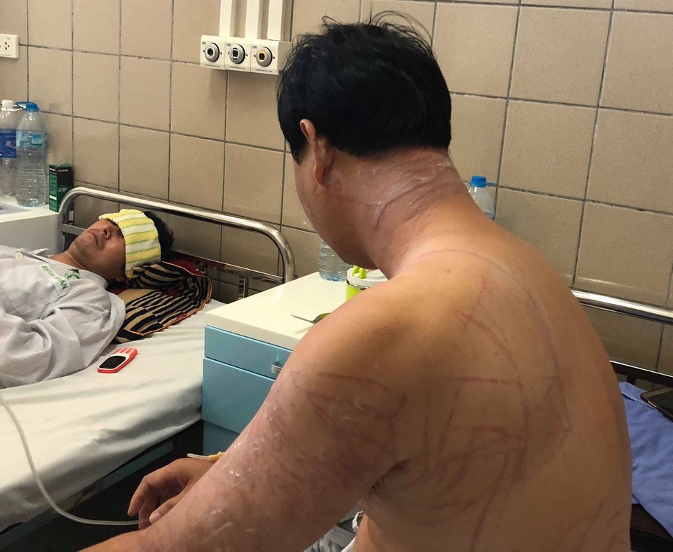 Sứa khổng lồ tấn công, du khách chằng chịt vết thương trên lưng như roi đánh - 2 Toàn bộ vùng cổ, lưng bệnh nhân chằng chịt vết đốt do sứa cuốn vào. Ảnh: H.Hải