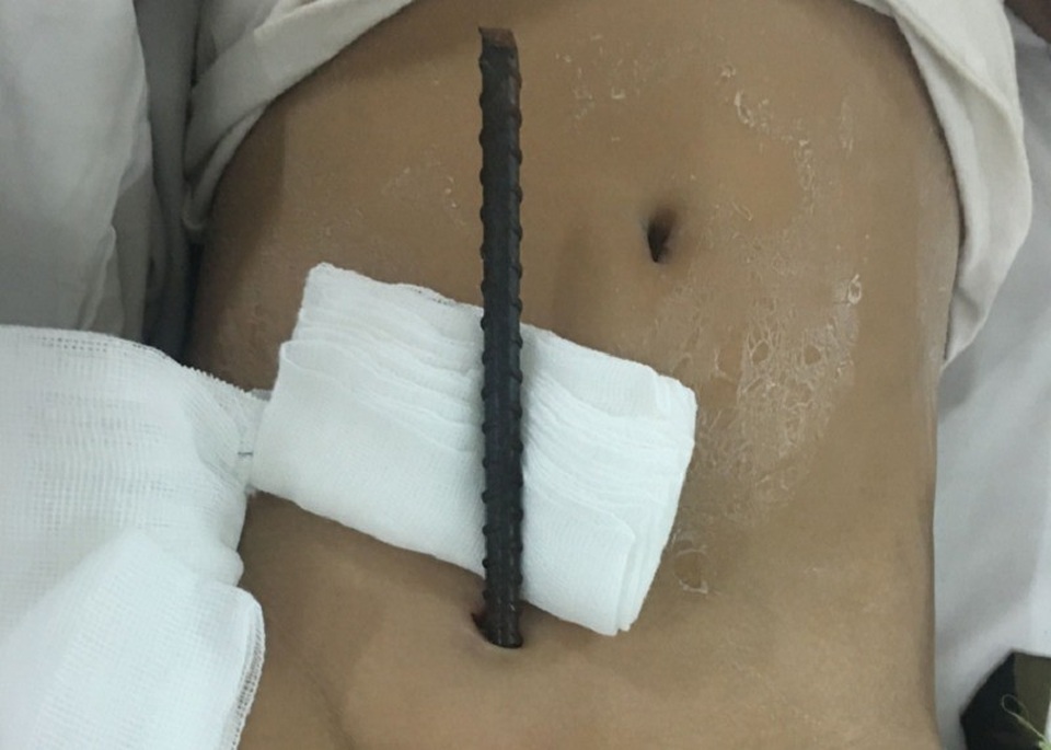 Bé 8 tuổi bị cây sắt xuyên từ vùng kín lên bụng - 1 Bệnh nhi nhập viện với cây sắt đâm xuyên từ vùng kín lên bụng