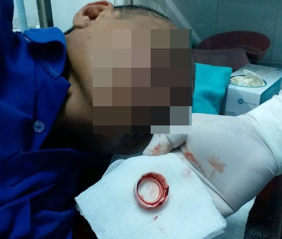 Suýt gặp nguy vì nắp chai nhựa kẹt giữa cuống họng - 1 Ông D. suýt gặp nguy vì nuốt phải nắp chai nhựa và bị kẹt trong cuống họng.