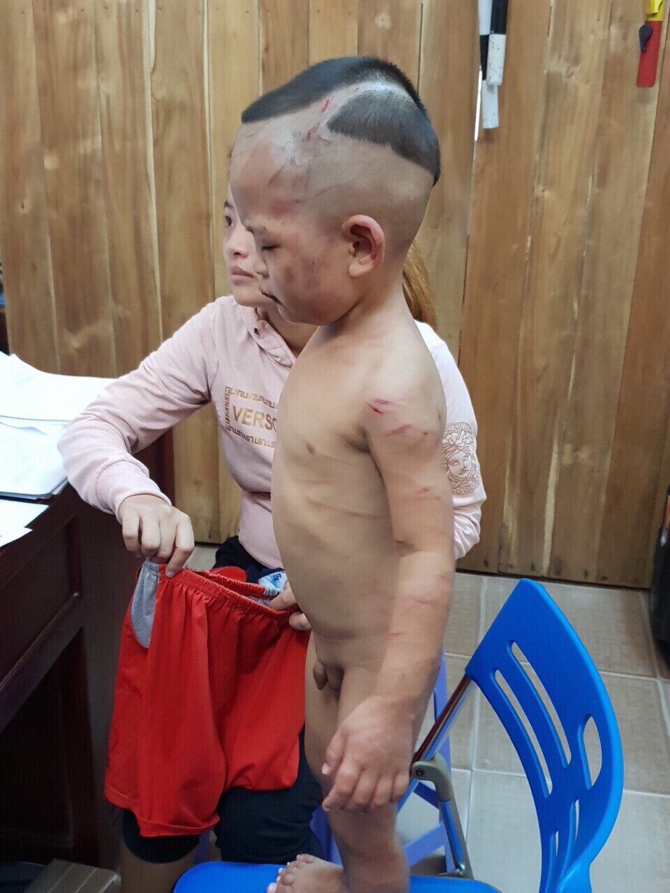 Cha dượng ra tay đánh bé 3 tuổi dã man - 1 Bé Lê Hoàng Huy khi được công an giải cứu... toàn thân cháu đầy thương tích (ảnh CTV)