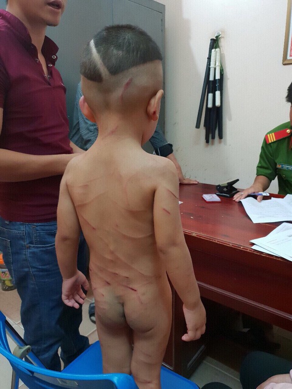 
Cháu bé 3 tuổi ở Phú Quốc, Kiên Giang bị cha dượng đánh đập dã man chỉ vì cháu quấy khóc và không chịu ngủ trưa (Ảnh: CTV)
