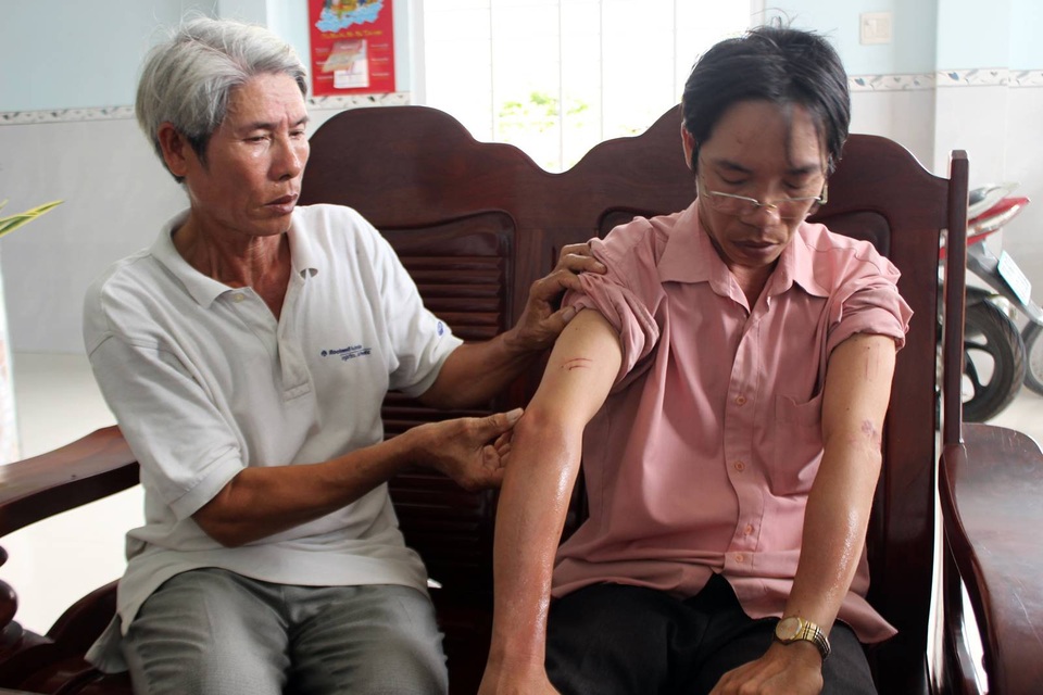 Dùng roi điện, bình xịt hơi cay cướp đi hàng chục cây vàng - 2
Trên người anh Truyền còn nhiều vết bỏng do bình xịt hơi cay và roi điện gây ra.