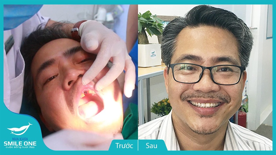 Cấy ghép Implant Surface Slactive 5D - Trọn vẹn một nụ cười! - 3 Bệnh nhân Hùng (52 tuổi) trước và sau khi cấy ghép Implant