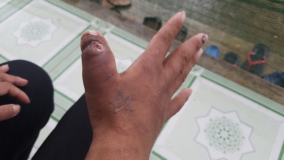 Vụ bạo hành người giúp việc: Nạn nhân khai nhiều hình thức bị tra tấn - 2 Các ngón tay bị bà Nga tra tấn