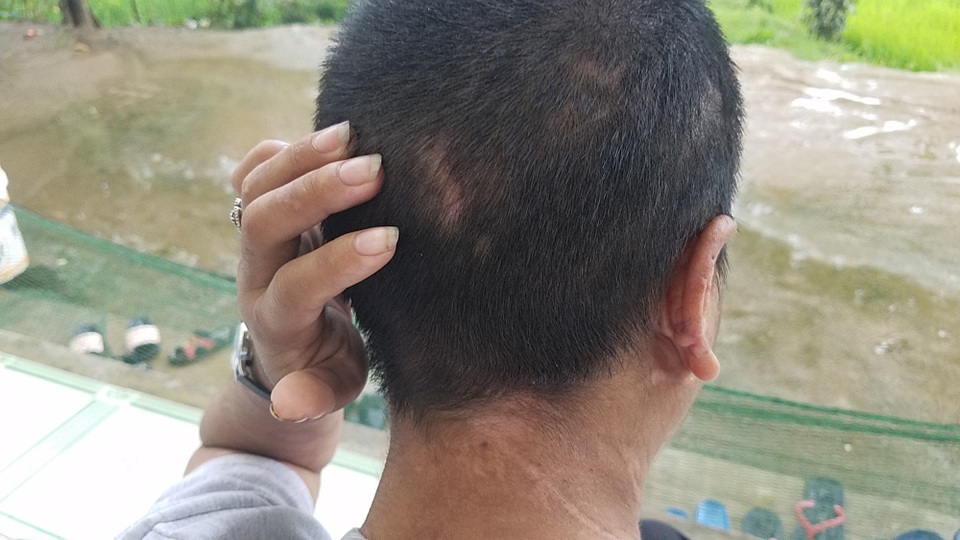 Vụ bạo hành người giúp việc: Nạn nhân khai nhiều hình thức bị tra tấn - 1 Các vết thương trên người Y Nhiêu đang dần hồi phục