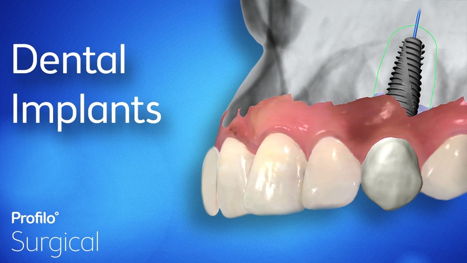 Trồng răng Implant và những điều bạn cần lưu ý - 1 Trồng răng Implant và những điều bạn cần lưu ý - 1