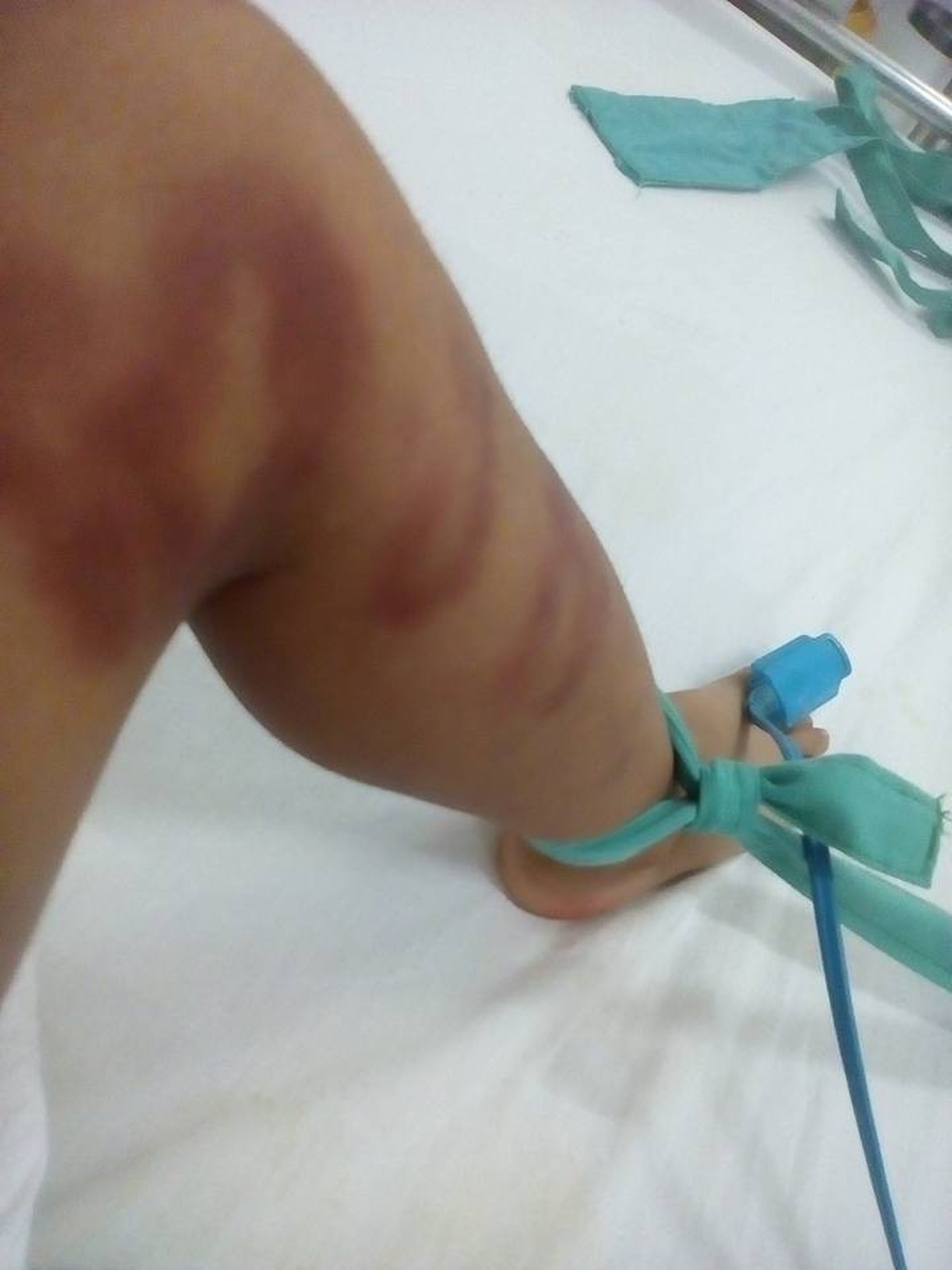 Bắt khẩn cấp đối tượng nghi bạo hành con riêng của "vợ hờ" - 2 Chân bị nhiều vết thương nặng