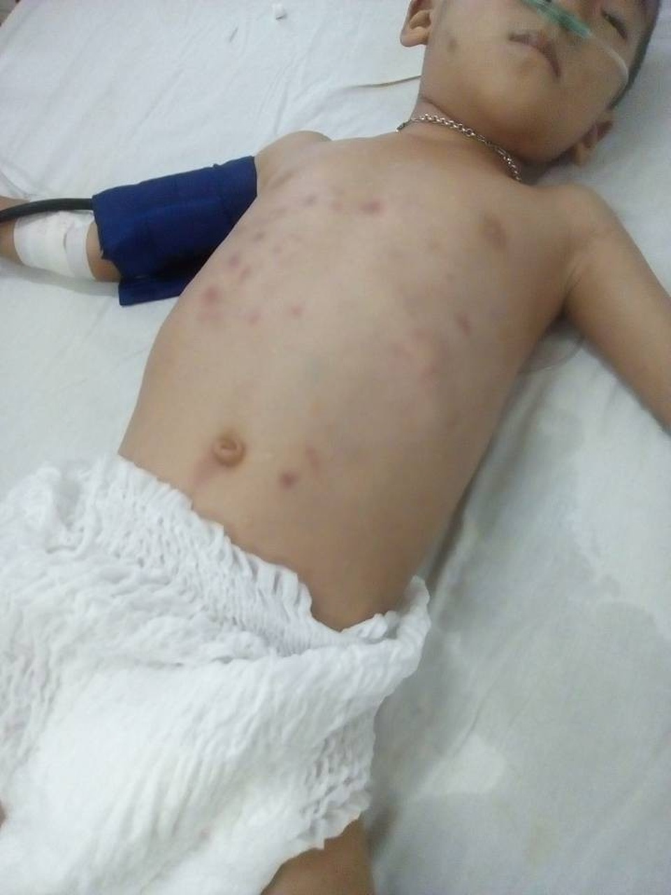 Bắt khẩn cấp đối tượng nghi bạo hành con riêng của "vợ hờ" - 1
Cháu Đ.X.L. nghi bị bố dượng bạo hành, đánh đập dã man với nhiều vết bầm tím trên người.