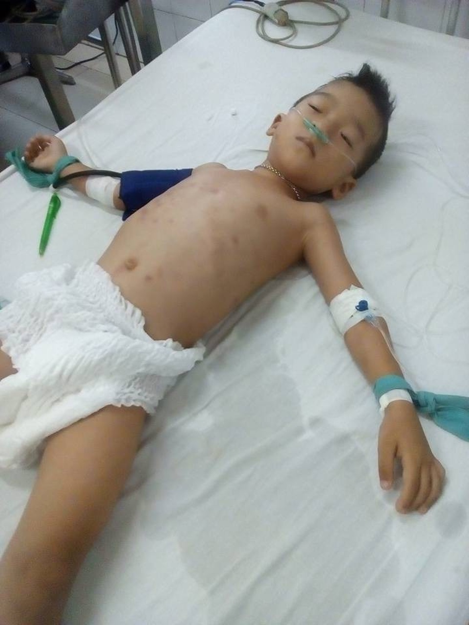 Cháu Đ.X.L. hiện đã qua đợt phẫu thuật đầu tiên